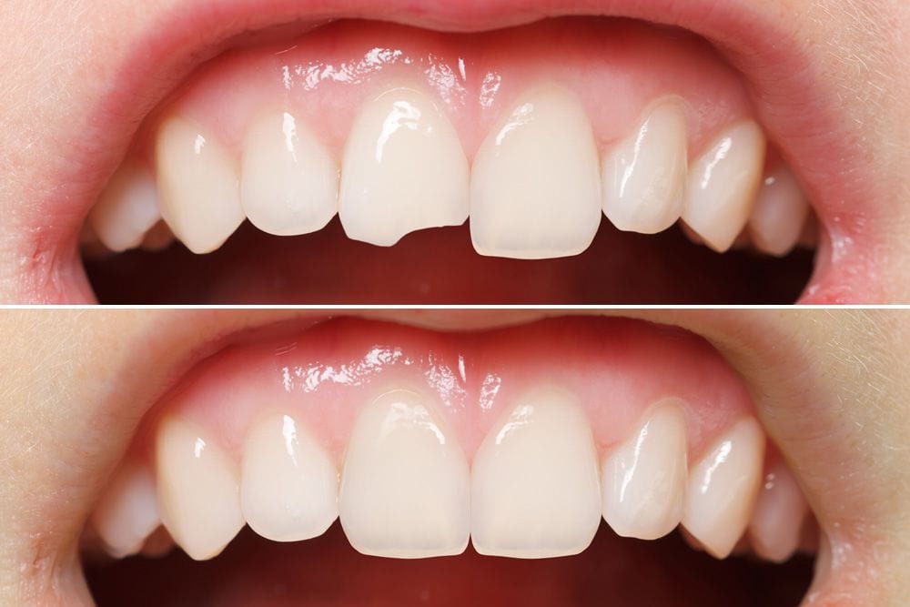 Tooth bonding for gaps between teeth and chipped teeth