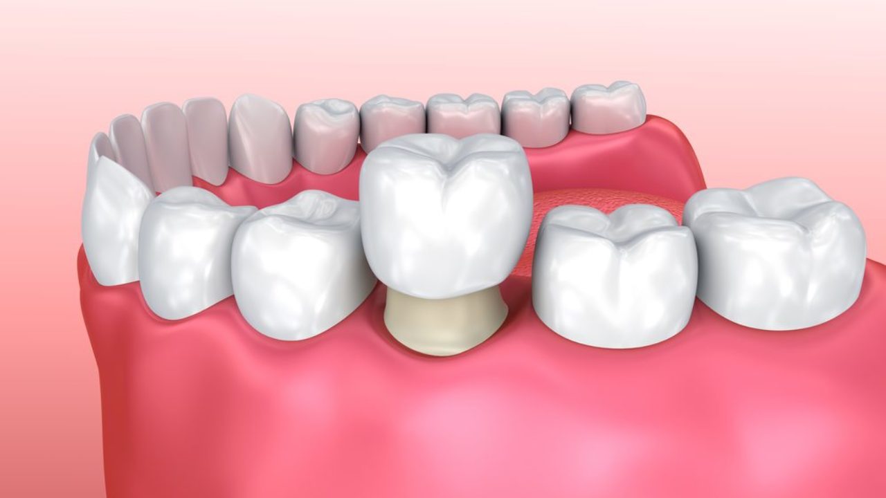 Everything You Need To Know About Dental Crowns | Burlington, NC