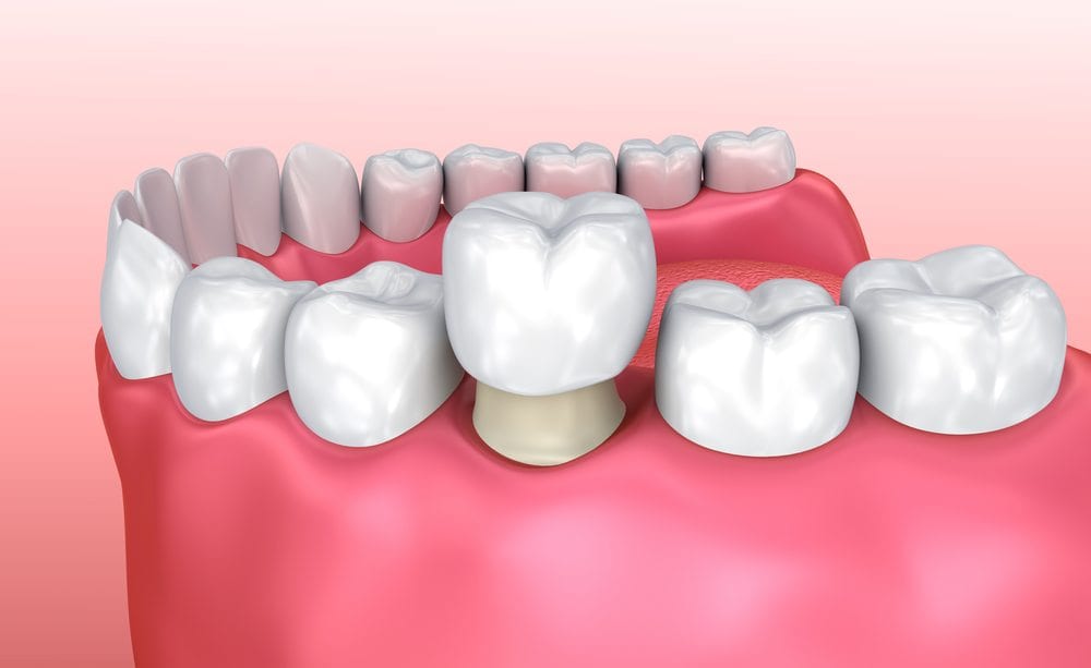 Everything You Need To Know About Dental Crowns