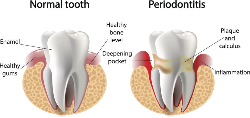 Bleeding Gums treatment in Burlington NC