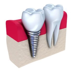 Burlington dental implants for adults