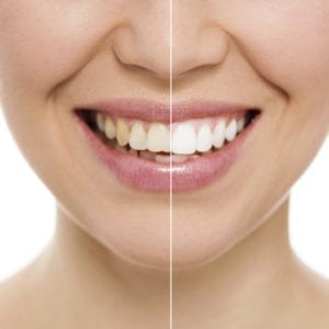 Teeth whitening for yellow teeth in Burlington NC
