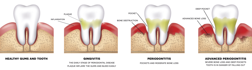 Treatment of periodontal disease and gingivitis