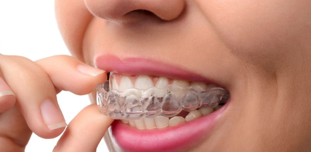 Transform Your Smile With Invisalign in Burlington NC