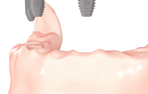 All-on-four dental implants in Burlington NC