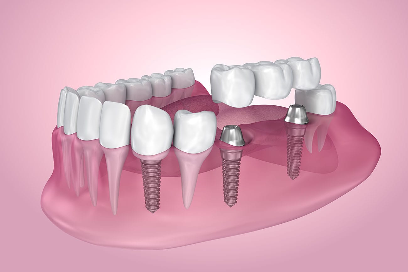 dental implants burlington nc