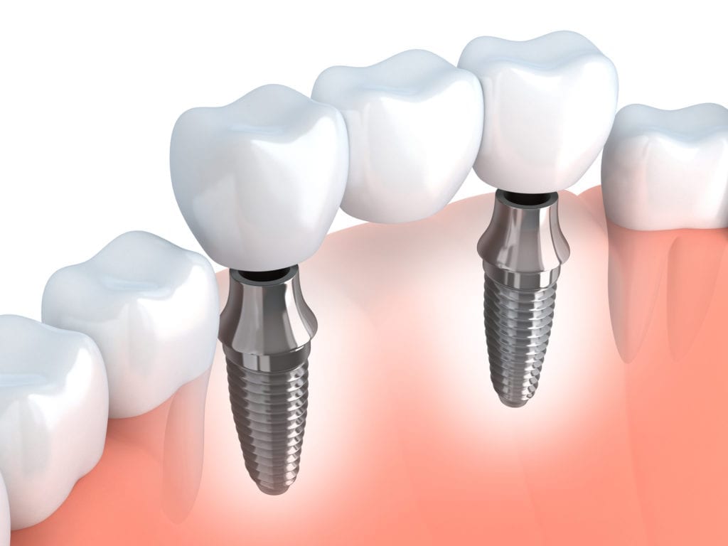 dental implants in Burlington North Carolina