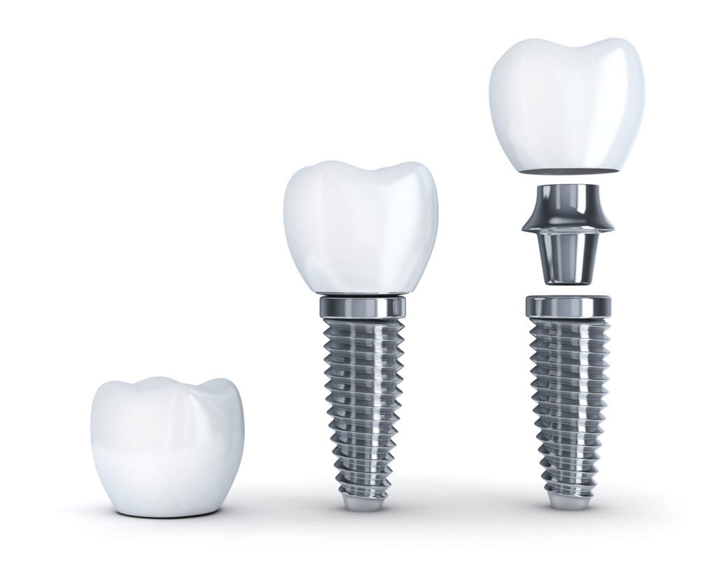 Burlington North Carolina dental implants