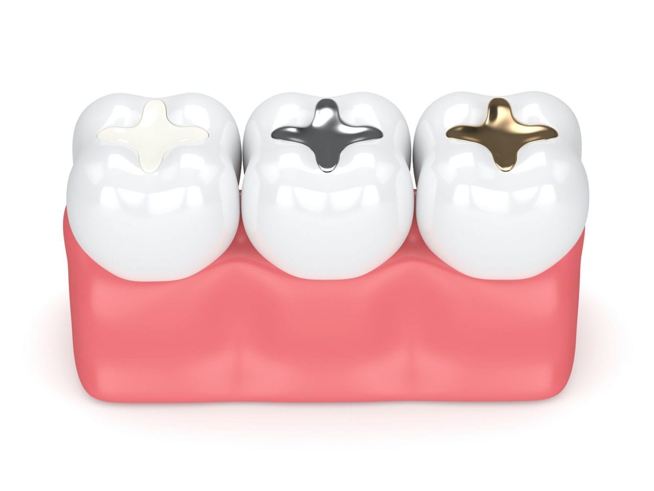 The Types of Dental Fillings Dentists in Burlington NC