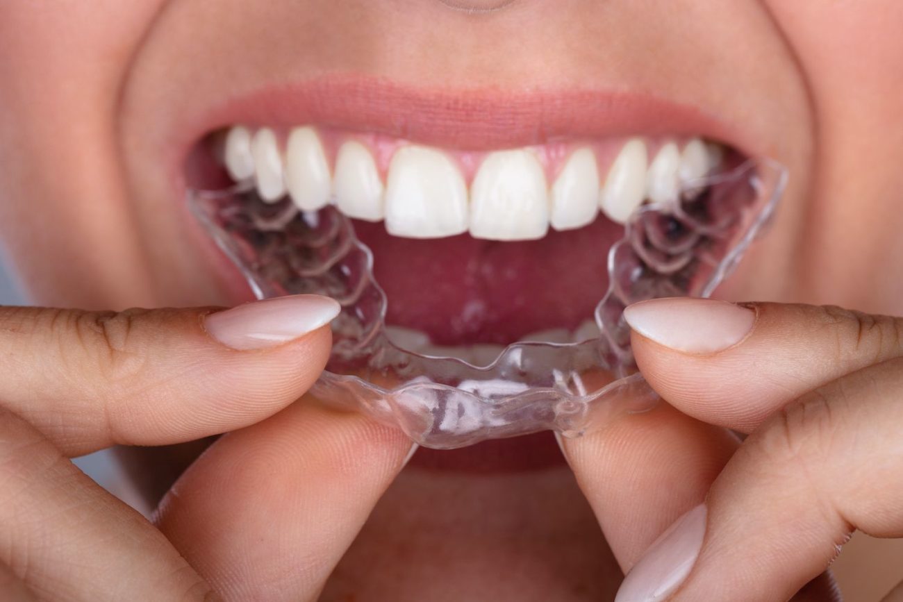 Invisalign Clear Braces in Burlington ON - Orthodontic Treatment