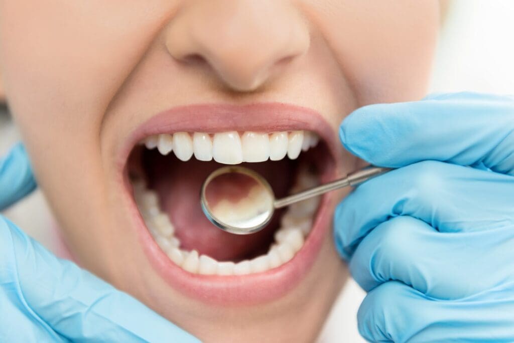 treat cavities in Burlington, NC