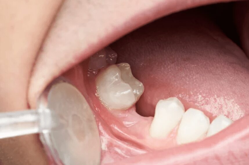 close up image of gums with missing teeth dental tool pulling back lips to see gums restorative dentistry dentist in Burlington North Carolina