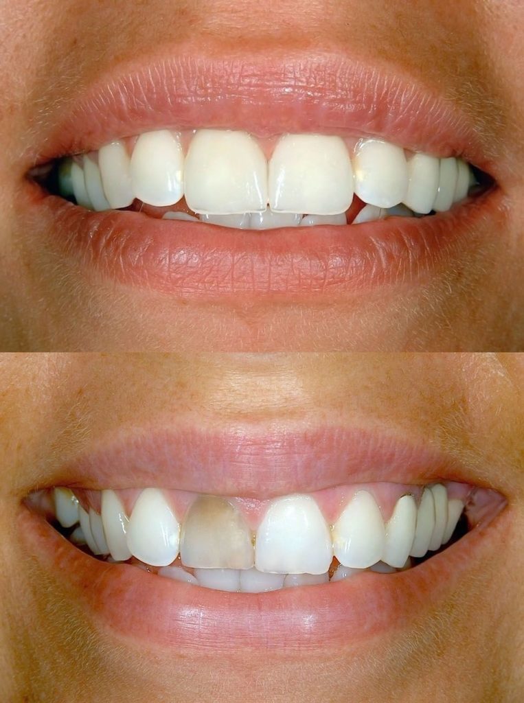 Before and after image of smile with coloration issues tooth bonding cosmetic dentistry dentist in Burlington North Carolina