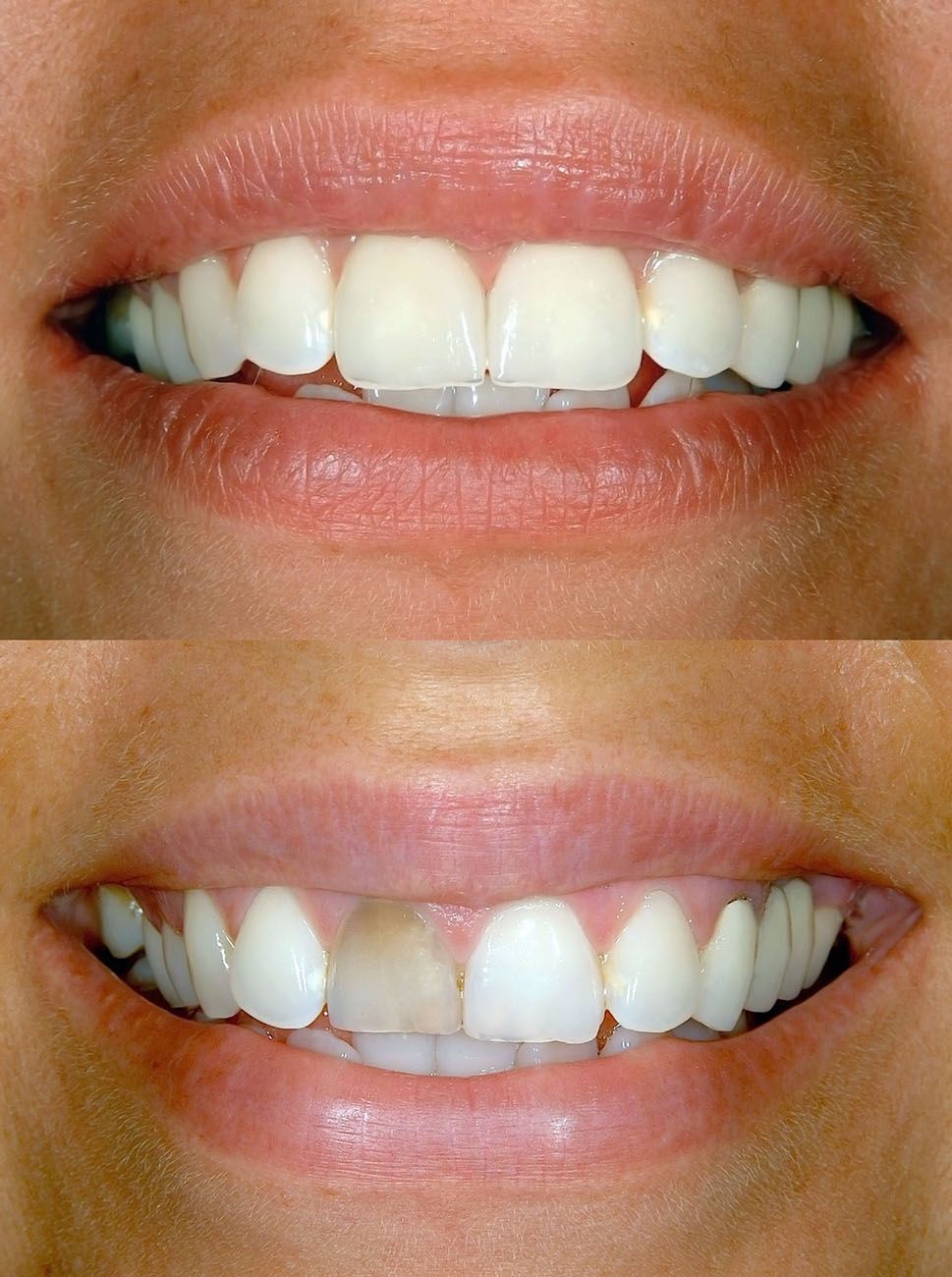 Dental Composite Bonding (Cosmetic)