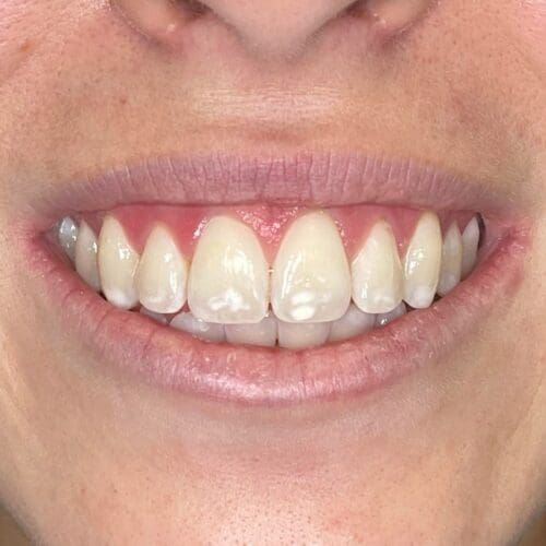 Before cosmetic dentistry in Burlington NC