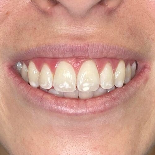 Before cosmetic dentistry in Burlington NC