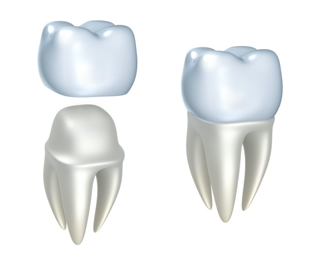 Dental Crowns in Burlington NC are the restoration of choice after an implant
