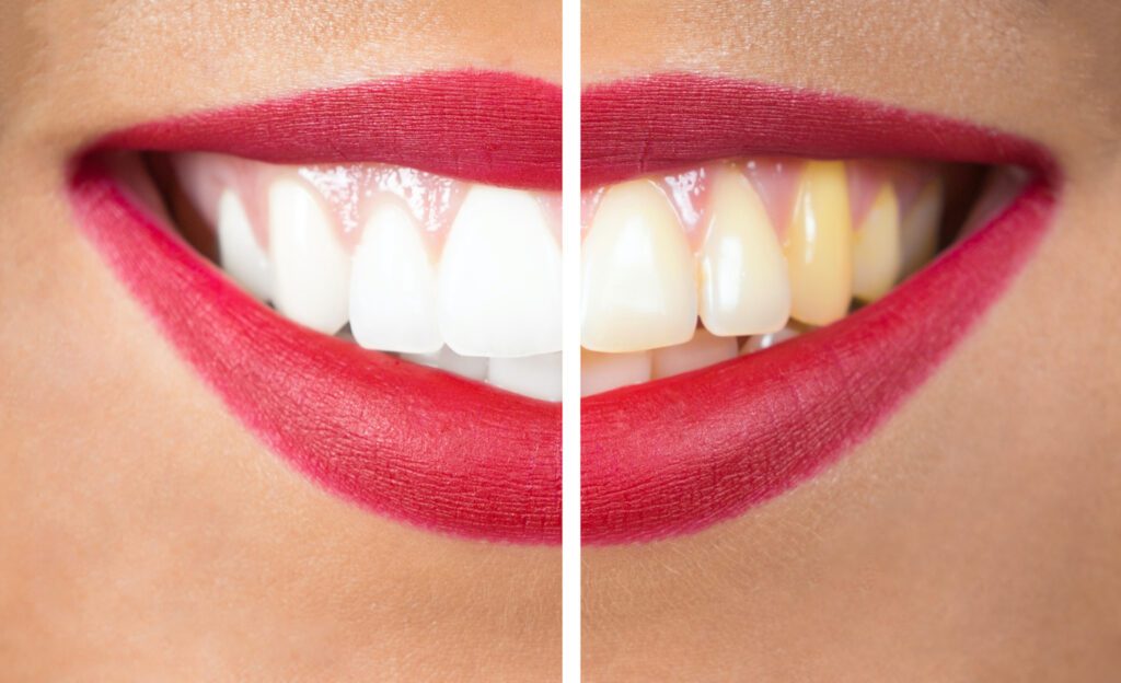 Teeth Whitening in BURLINGTON NC can help professionally improve the look of your smile