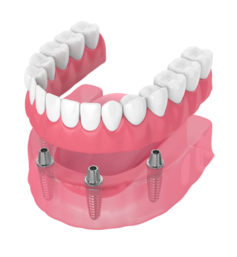 All-on-Four dental implants have transformed the field of restorative dentistry, providing patients with a reliable and long-lasting option.