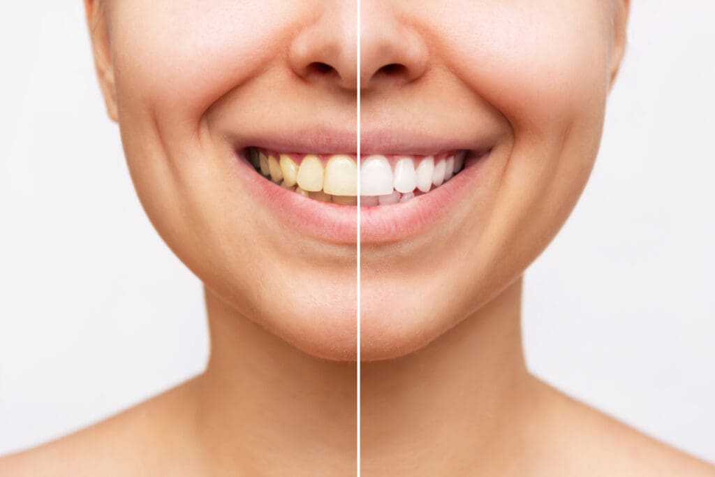 Teeth Whitening in Burlington North Carolina