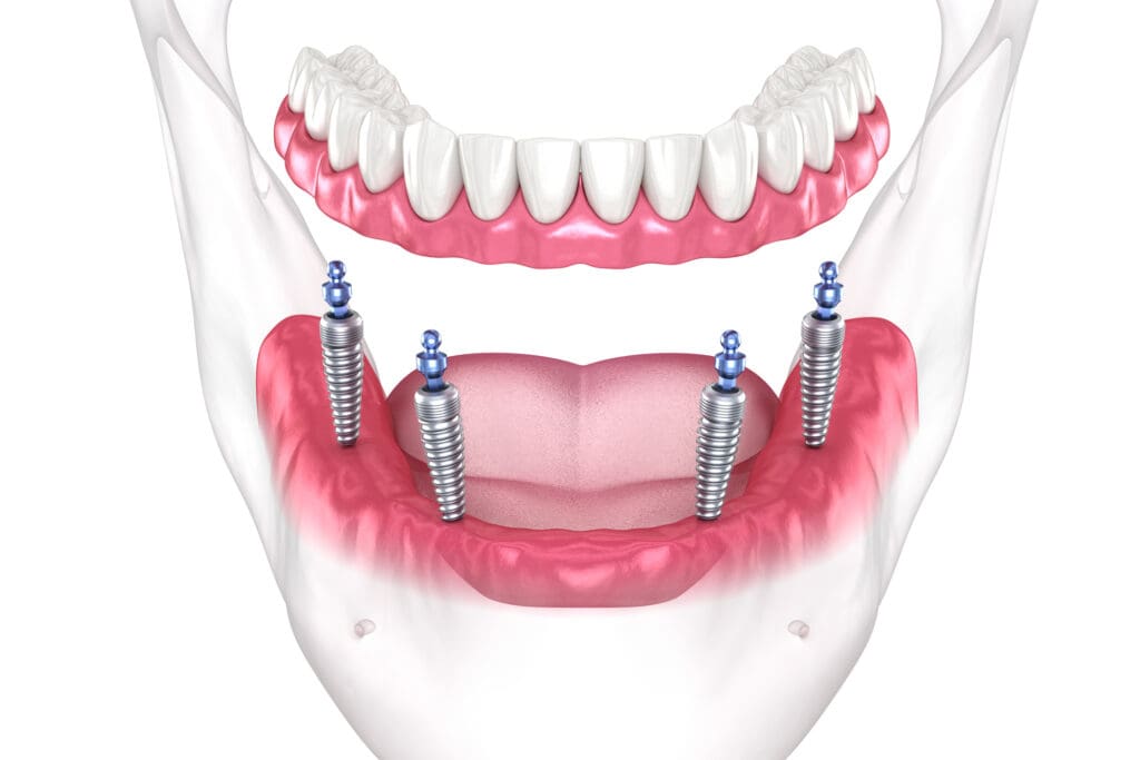 Impmant Secured Denture Burlington, N?C