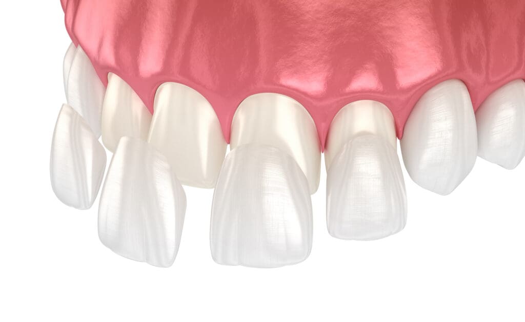 Affordable Porcelain Veneers in Burlington North Carolina