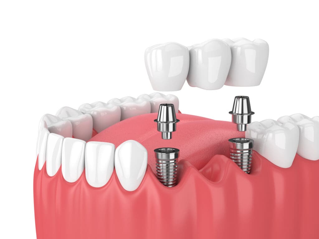 dental implants in Burlington North Carolina