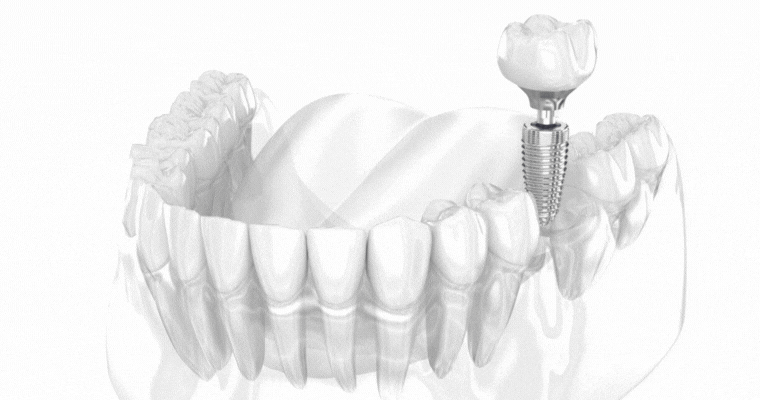 Dental Implants in Burlington NC
