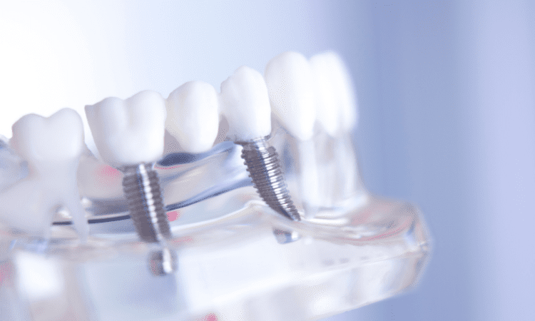 Dental implants have emerged as a leading solution for restoring both the function and aesthetics of natural teeth.